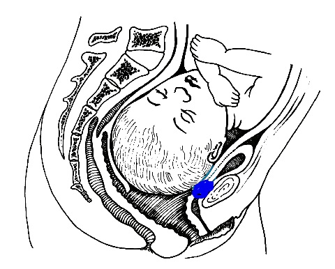 vesco vaginal fistula Vesco vaginal fistula